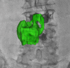 Three-dimensional–two-dimensional registration and overlay of a
tumor (L3/L4 renal cell tumor) segmented from MRI, registered via cone-beam
CT, and overlaid on real-time fluoroscopy. Prior kyphoplasty is also
evident.