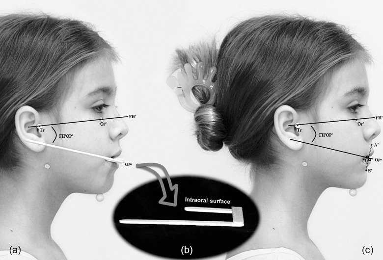 Figure 6. Photographic measurements. Sagittal assessment: (1) Wits', soft-tissue maxillomandibular linear discrepancy. (A) Patient occluding a wooden spatula device. (B) Schematic representation of the device. (C) Distance A'-B' obtained after the transfer of FH'OP' angle to the photograph held in maximum intercuspation.