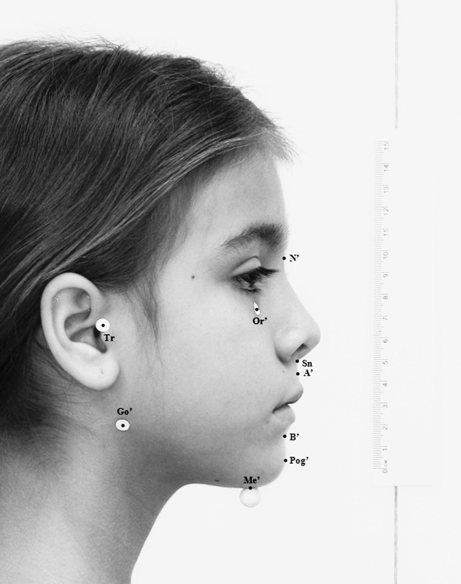 Figure 1. '  =  Photographic landmarks. N' indicates soft tissue nasion; Tr, tragion; Or', soft tissue orbitale; A', soft tissue subspinale; B', soft tissue supramentale; Go', soft tissue gonion; Pog', soft tissue pogonion; Me', soft tissue menton; Sn, subnasale. Adhesive dots were placed on Tr, Or', and Go'. The Me' point was marked with an adhesive styrofoam bead to allow better visibility by the camera.