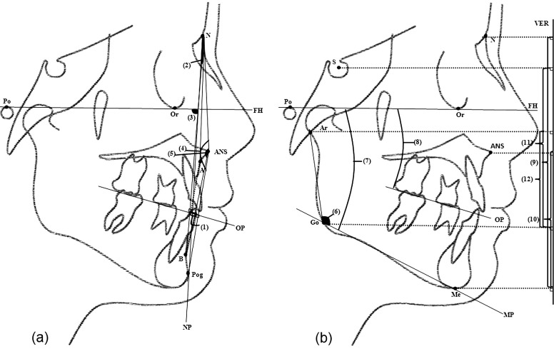 Figure 5. Cephalometric measurements. (A) Sagittal assessment: (1) Wits, maxillomandibular linear discrepancy; (2) ANB, maxillomandibular angular discrepancy; (3) FNP, facial angle; (4) N.ANS.Pog; and (5) N.ANS.B, angles of facial convexity. (B) Vertical assessment: (6) Ar.Go.Me, gonial angle; (7) FMA, Frankfurt to mandibular plane angle; (8) OPA, Frankfurt to occlusal plane angle; (9) AFH (N-Me), anterior facial height; (10) LAFH (ANS-Me), lower anterior facial height; (11) PFH (S-Go), posterior facial height; and (12) LPFH (Ar-Go), lower posterior facial height.