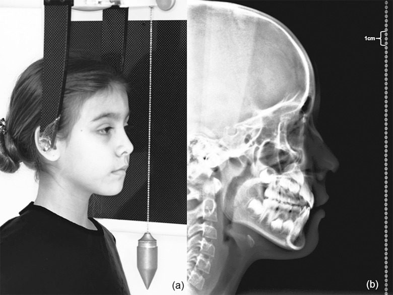 Figure 4. (A) Subject placed in the cephalostat. (B) Digital radiographic record.