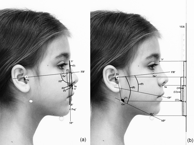 Figure 7. Photographic measurement continuation of Figure 6. (A) Sagittal assessment: (2) A'-B' perp, soft tissue maxillomandibular linear discrepancy; (3) A'N'B', soft tissue maxillomandibular angular discrepancy; (4) FNP', soft-tissue facial angle; (5) N'.Sn.Pog'; (6) N'.Sn.B', soft tissue angles of facial convexity. (B) Vertical assessment: (7) Tr.Go'.Me', soft tissue gonial angle; (8) FMA', soft tissue Frankfurt to mandibular plane angle; (9) OPA', soft tissue Frankfurt to occlusal plane angle; (10) AFH' (N'-Me'), soft tissue anterior facial height; (11) LAFH' (Sn-Me'), soft tissue lower anterior facial height; and (12) PFH' (Tr-Go'), soft tissue posterior facial height.