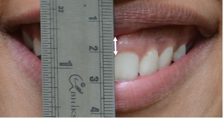 Figure 3a: Pre-treatment – Close-up Posed smile.