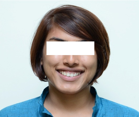 Figure 5b: Post-treatment - Unposed smile.