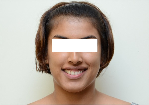 Figure 2a: Pre-treatment - Posed smile.