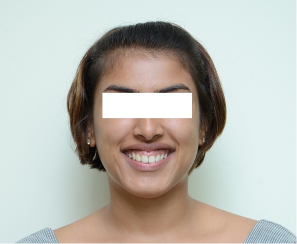 Figure 2b: Pre-treatment - Unposed smile.