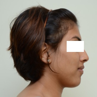 Figure 1: Pre treatment photo – Profile view.