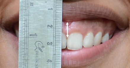 Figure 3b: Pre-treatment – Close-up Posed smile.