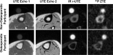 Representative MRI axial magnitude scans for each noncontrast sequence
compared between a 70-year-old woman with osteoporosis (OP; osteoporotic
participant) and a 62-year-old woman without OP (non-osteoporotic
participant). The circular structure above the tibia is the calibration
reference sample that converts signal intensities to absolute
concentrations. The sample concentrations and relaxation times are
approximately matched to those of the bone water properties and are
therefore not visible on the ultrashort echo time (UTE) echo 2 image. The
UTE images in the participant with OP exhibit the characteristic cortical
thinning from periosteal expansion and endosteal resorption. The phosphorous
31 (31P) zero–echo time (ZTE) image indicates a general reduction in
the phosphorus signal in the OP subject. IR = inversion recovery, r-UTE =
rapid UTE.
