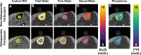 Representative cortical segmentation and quantitative parametric color
maps overlaid on ultrashort echo time (UTE) images for the same women
pertaining to Figure 2. (A) Yellow boundaries depict manually drawn contours
of cortical bone overlaid on a UTE echo 2 image, which has strong
bone-tissue contrast. Color maps for each MRI parameter, (B) total water,
(C) pore water, (D) bound water, and (E) phosphorous, are overlaid on UTE
echo 1 images. ROI = region of interest.