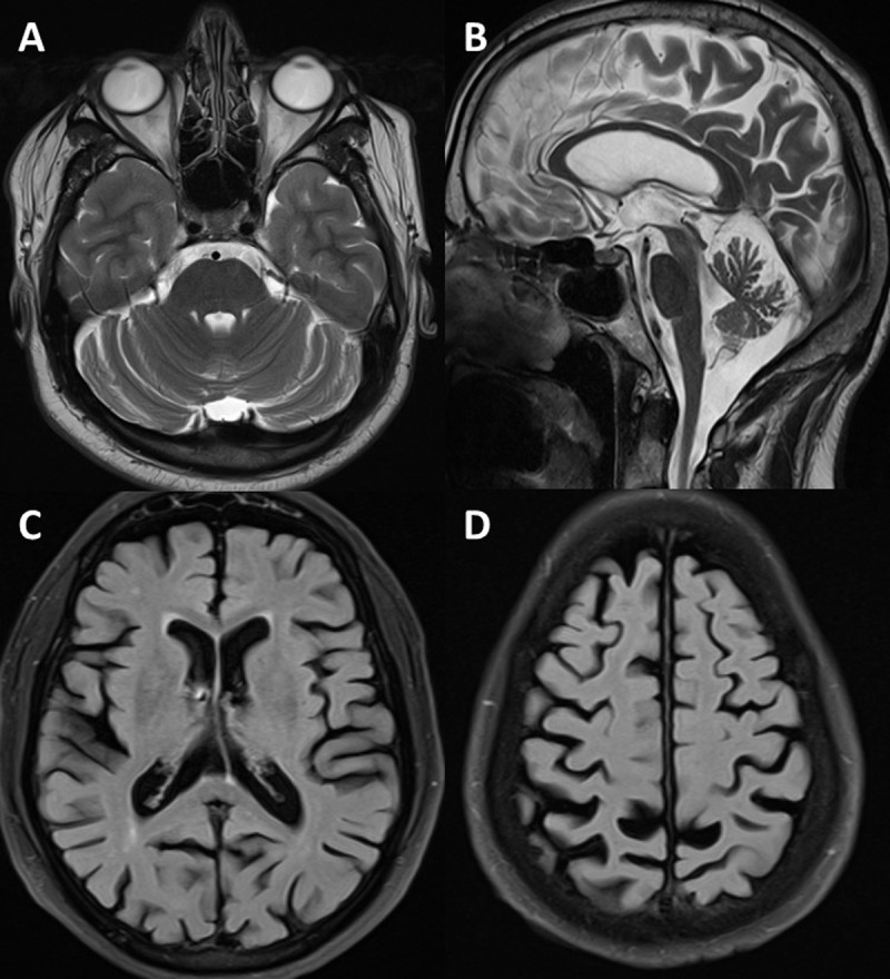 MRI brain showing cerebellar atrophy