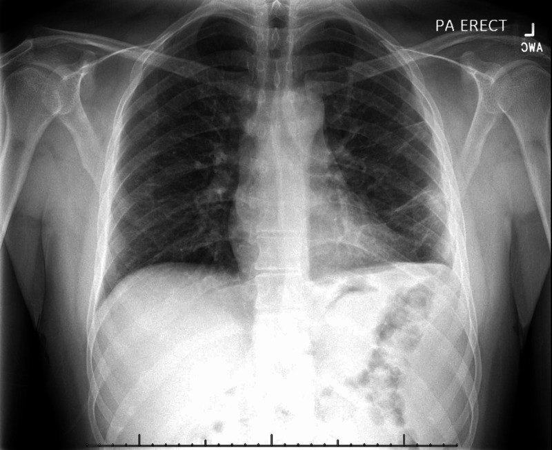 pleural-tuberculosis-a-febrile-presentation-without-respiratory
