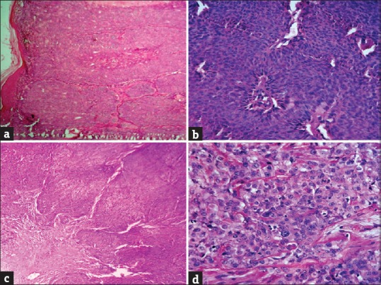 Histopathological Analysis of Skin Adnexal Tumors: A Three Year Study ...