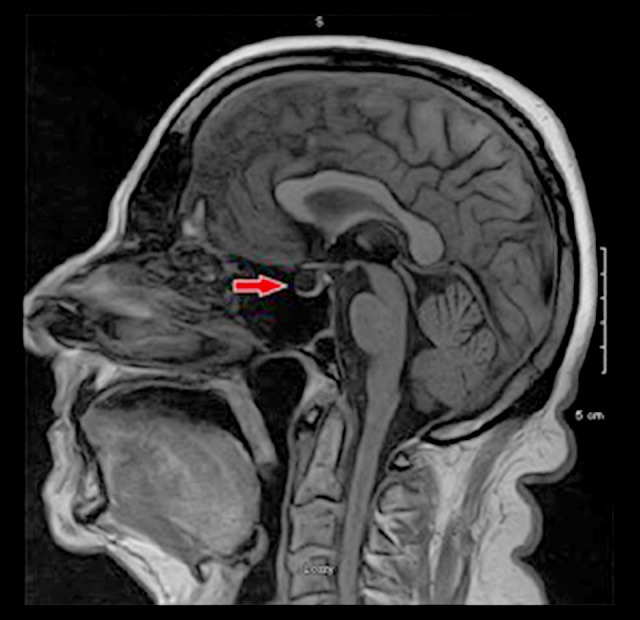 Sinus Bradycardia as a Rare and Unusual Presentation of Partial Empty ...