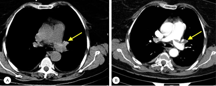 Evaluating The Performance Of Unenhanced Computed Tomography In The Diagnosis Of Pulmonary