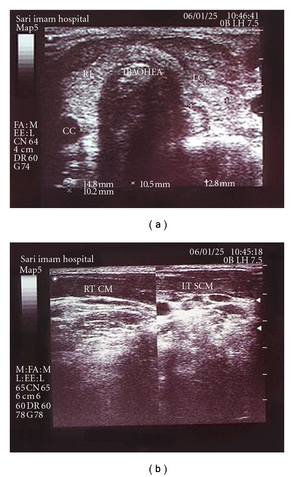 Variable clinical presentations of riedel s thyroiditis report of two