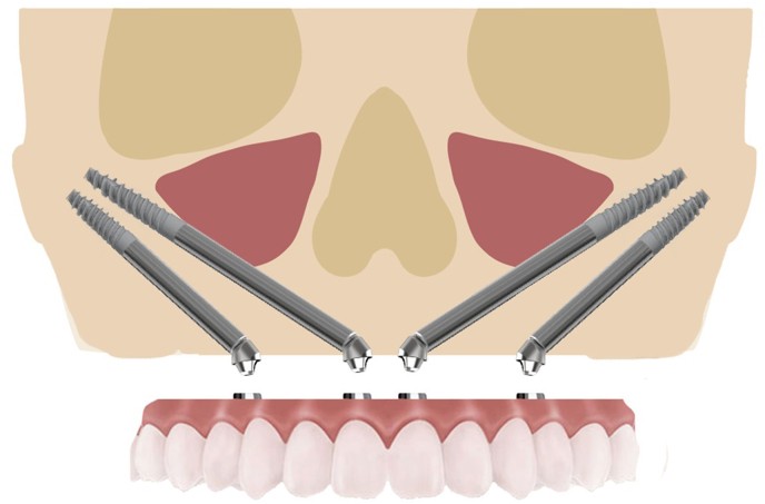 Fig. 13