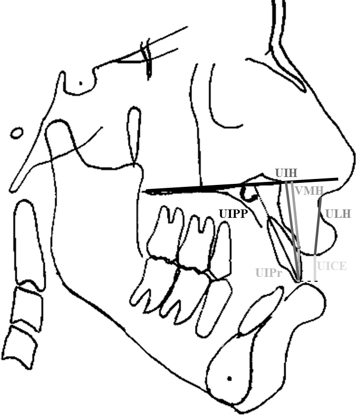 Figure 1. Angular and linear measurements. UICE indicates upper incisor crown exposure; UIPP, upper incisor to palatal plane; UIH, upper incisor height; VMH, vertical maxillary height; UIPr, prosthion to incisal border of the UI; ULH, upper lip height.