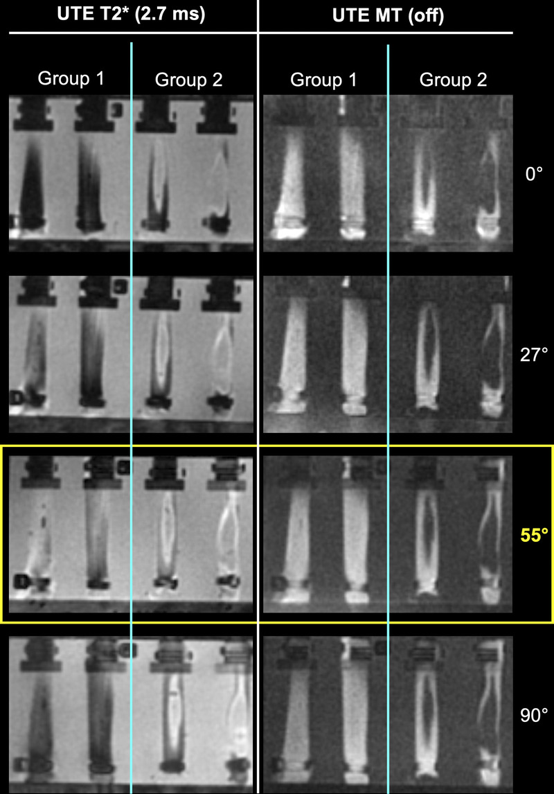 Quantifying Tendon Degeneration Using Magic Angle Insensitive Ultra ...