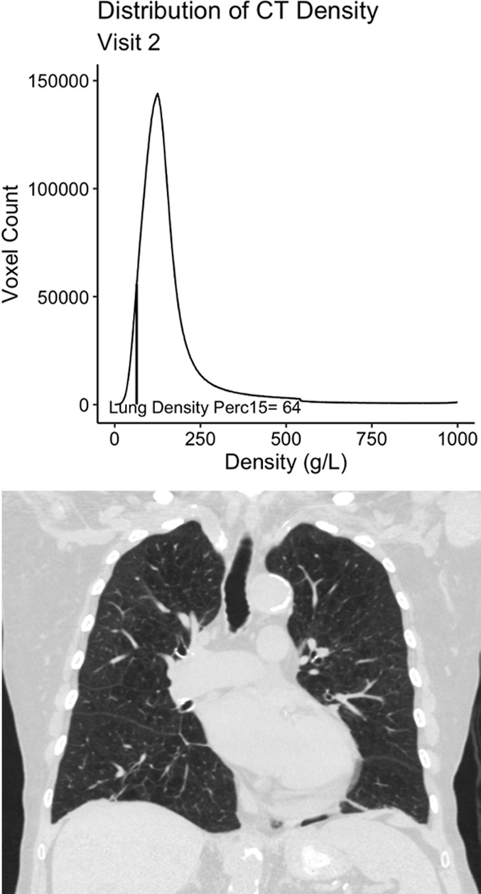 Example 77-year-old female participant from the chronic pulmonary obstructive disease (COPD) gene (COPDGene) cohort with evidence of quantitative emphysema progression but no clear visual progression of emphysema over 5 years who ultimately died during long term follow-up. (a) A representative coronal noncontrast CT image and the associated CT density histogram for the participant at baseline. (b) A representative noncontrast-enhanced coronal CT image and the associated CT density histogram for the participant at the 5-year follow-up visit. Lung density perc15 = volume-adjusted lung density measured at the 15th percentile of the CT lung density histogram.