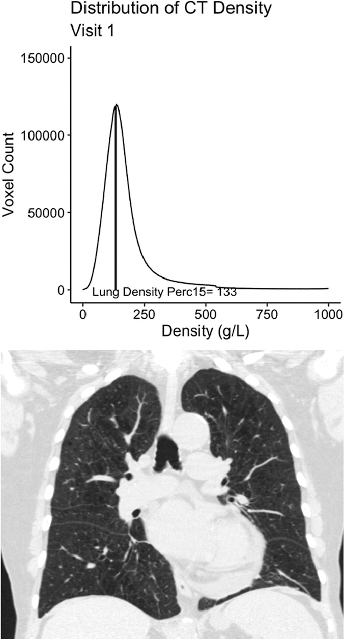 Example 77-year-old female participant from the chronic pulmonary obstructive disease (COPD) gene (COPDGene) cohort with evidence of quantitative emphysema progression but no clear visual progression of emphysema over 5 years who ultimately died during long term follow-up. (a) A representative coronal noncontrast CT image and the associated CT density histogram for the participant at baseline. (b) A representative noncontrast-enhanced coronal CT image and the associated CT density histogram for the participant at the 5-year follow-up visit. Lung density perc15 = volume-adjusted lung density measured at the 15th percentile of the CT lung density histogram.