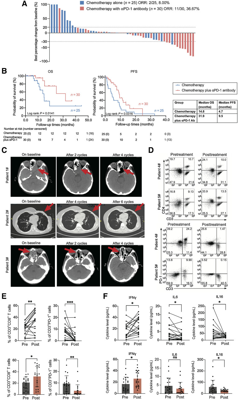 Figure 6. Tumor and antitumor immunity response in patients with RIS treated with anti–PD-1 antibody in combination with chemotherapy. A, The best percentage changes of all the RIS volume in patients treated with chemotherapy alone or the combination of chemotherapy and anti–PD-1 antibody. Dashed lines indicate RECIST criteria for progressive disease (+20%) or partial response (–30%). B, OS and PFS of patients with RIS treated with the combination of chemotherapy and anti–PD-1 antibody or chemotherapy alone. C, CT imaging of representative patients with RIS treated with anti–PD-1 antibody combined with chemotherapy. Each row represents one patient. Red arrows indicate the tumor lesions. D, Typical dot plots for flow cytometry detection of immune cells in patient blood pre- and posttreatment. E, Percentages of CD3+CD8+ T cells and PD-1+CD3+ cells in pre- and posttreatment peripheral blood from 18 patients with RIS treated with the combination therapy. F, Pre- and posttreatment plasma levels of IFNγ, IL6, and IL16 in 18 patients in the combination treatment group. Paired t test, ***, P < 0.001; **, P < 0.01; *, P < 0.05. Error bars indicate mean ± SD.