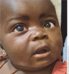 Photo of a child with secondary congenital glaucoma