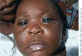 Photo of a child with enlarged eyes