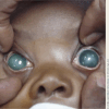 Photo of infant with primary congenital glaucoma