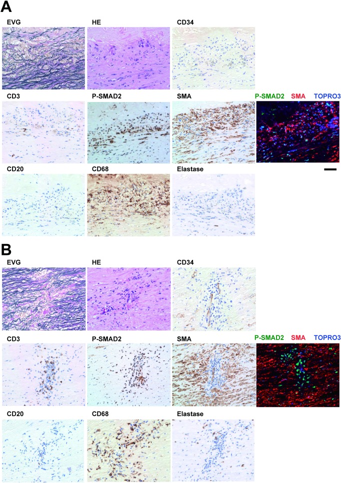 Fig. 3 Characterization of the TAA tissue with activated SMAD2. Representative images are shown for the areas corresponding to the layer-like staining of P-SMAD2 (A) and spot-like staining of P-SMAD2 (B). Photomicrograms indicate histochemical staining with EVG and H & E, and immunohistochemical staining for the T cells (CD3), P-SMAD2, smooth muscle cells (SMA), B cells (CD20), macrophages (CD68) and neutrophils (Elastase). Nuclear staining with hematoxylin in immunohistochemical stainings served as counter staining. Photomicrograms of the immunofluorescence staining for P-SMAD2 (green), SMA (red), and nuclei (TOPRO3, blue) are also shown. Bar 50 µm.