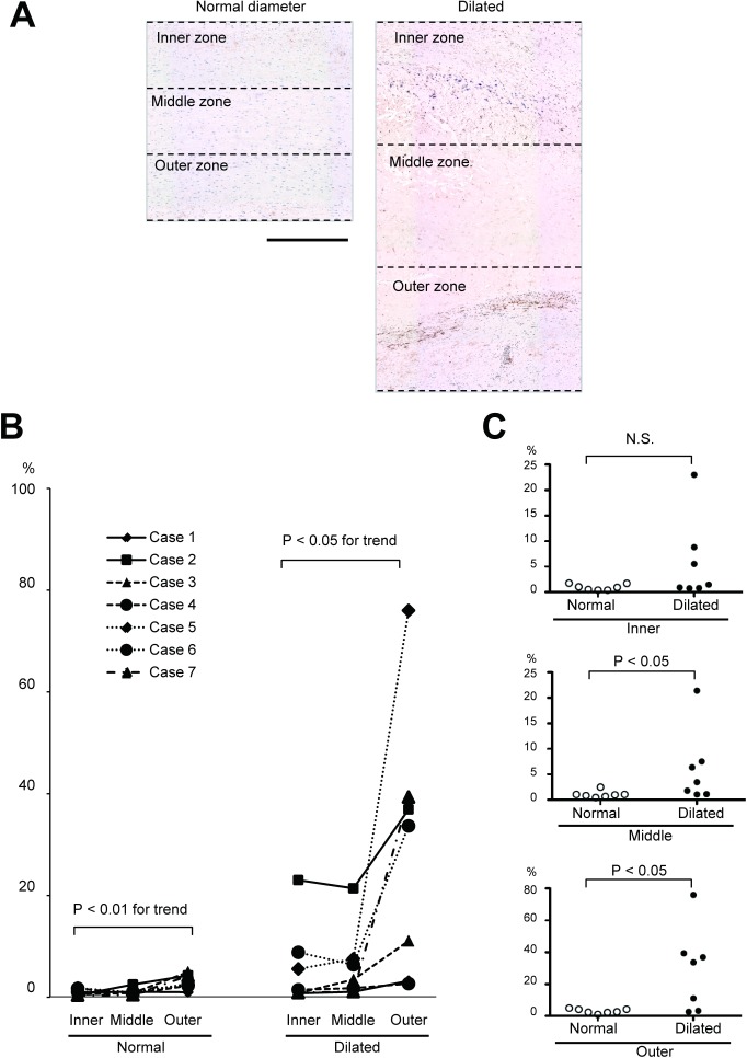 Fig. 2 Quantitative analysis of SMAD2 activation. (A) Diagrams show the aortic samples with P-SMAD2 staining to indicate the aortic walls with normal diameter (left) and with the maximal diameter of TAA (right) to divide into three zones with equal thickness. Bar 500 µm. (B) A graph shows the ratios of P-SMAD2-positive area to the corresponding zonal area in the samples with a normal diameter (left) and those with maximal diameter of TAA (right). The same symbols indicate the values obtained from the same patient. (C) Graphs show the comparison of P-SMAD2-positive area ratios between the tissues with a normal diameter and those with the maximal diameter of TAA.