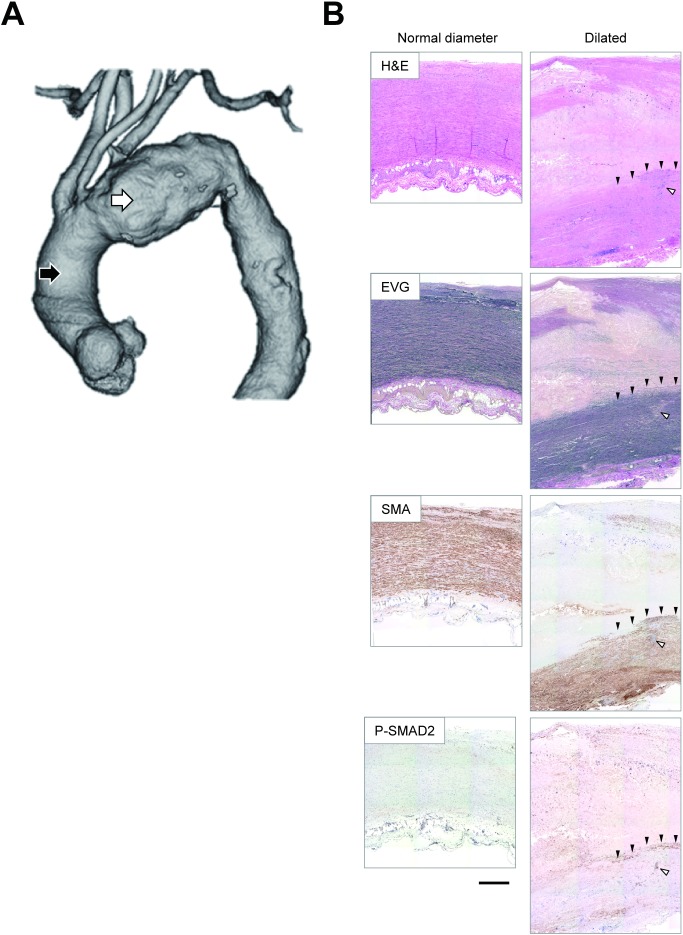 Fig. 1 Representative macroscopic and microscopic images of TAA. (A) A representative image of the three-dimensional reconstruction of the aorta with TAA, obtained using enhanced computed tomography. The black and white arrowheads indicate the sampling locations of the aortic walls with a normal diameter and those with maximal diameter, respectively. (B) Representative images are shown for the aortic walls with a normal diameter (left panels) and those with maximal diameter of TAA (right panels). Brown staining indicates the positive immunostaining signal of the corresponding antigens for SMA and P-SMAD2. Black arrowheads indicate the area corresponding to the layer-like staining of P-SMAD2. White arrowheads indicate the area corresponding to the spot-like staining of P-SMAD2. Bar 500 µm. H&E: hematoxylin & eosin staining; EVG: elastica van Gieson staining; SMA: smooth muscle α-actin as a marker for smooth muscle cells; P-SMAD2: phosphorylated (activated) SMAD2