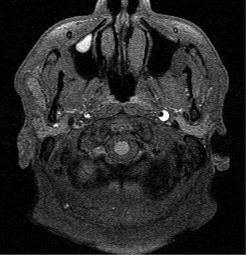 Isolated Oculomotor Nerve Palsy: A Rare Manifestation Of Internal 