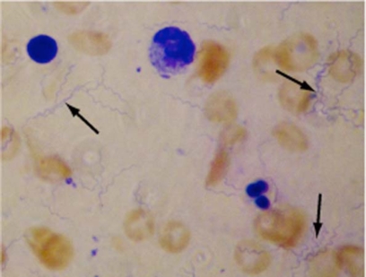 Fig. (2).Borrelia spirochetes concentrated from 10 ml blood and Giemsa stained.