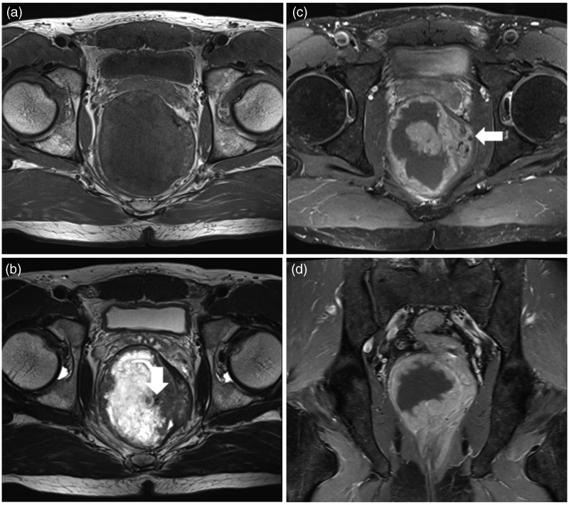 A Case Of Primary Rectal Angioleiomyoma Review Of Radiologic Finding With Histopathologic 6271