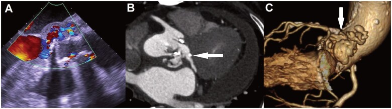 Root-commando operation for a ruptured left ventricular outflow tract - PMC