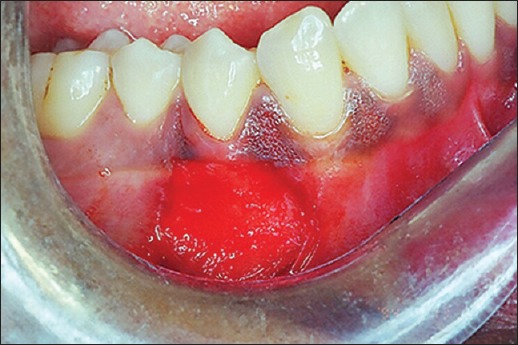 An acellular dermal matrix allograft (Alloderm®) for increasing ...