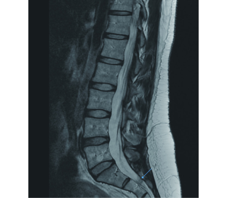 Intrathecal hematoma and sacral radiculitis following repeat epidural ...