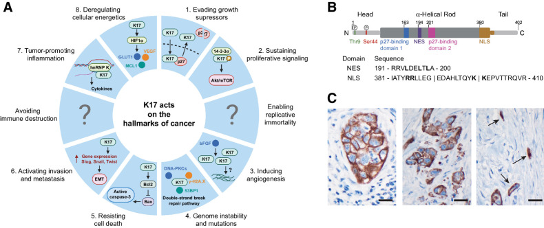 Figure 2. A, The implication of K17 in each of the 10 deadly hallmarks of cancer. K17 has a function in several hallmarks of cancer. Each piece of the pie chart resembles a hallmark of cancer and represents the mechanism K17 is reported to have in this hallmark, as highlighted in blue. The regions that contain a question mark portray a lack of evidence for K17 in this hallmark and signify that further studies are needed to see whether K17 works mechanistically in cells in this feature. B, Structure of K17. K17 is made up of an α-helical filament domain (residues 84–392) sectioned into four parts of repeated heptads (1A, 1B, 2A, and 2B), and nonhelical head (N terminal; residues 1–83) and tail (C terminal; residues 393–432) domains. K17 has a NES found between residues 191 and 200 of the filament domain and a NLS found between residues 381 and 410 of the protein. It has also been recently reported that there are two phosphorylation sites found on the N-terminal head domain of K17, serine 44 (Ser44) and threonine 9 (Thr9). C, IHC localization of K17 in PDAC. Note diverse patterns of stained tumor cells. Cohesive cluster of large tumor cells (left); smaller tumor cells and apoptotic debris (middle); K17 highlighting small diffusely infiltrative tumor cells, embedded in a densely desmoplastic stroma (right). Original magnification ×600; scale bars, 20 μm.