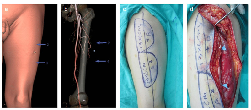 Comparison between preoperative and intraoperative body surface simulation positioning of CTA