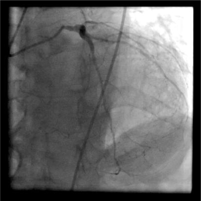 Ostial stenosis of the left main coronary artery as the result of the ...