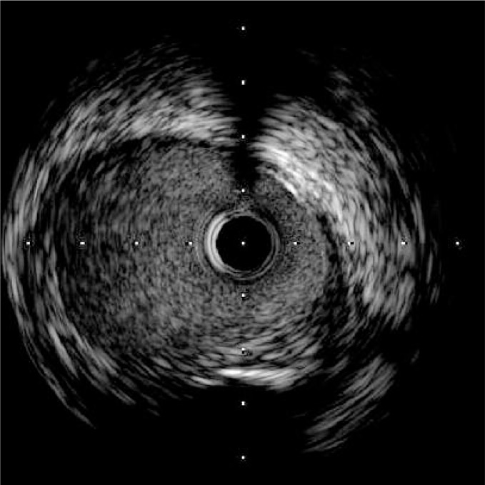 Ostial stenosis of the left main coronary artery as the result of the ...