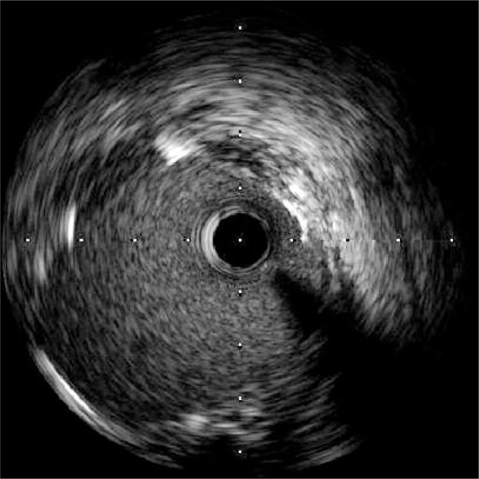 Ostial stenosis of the left main coronary artery as the result of the ...