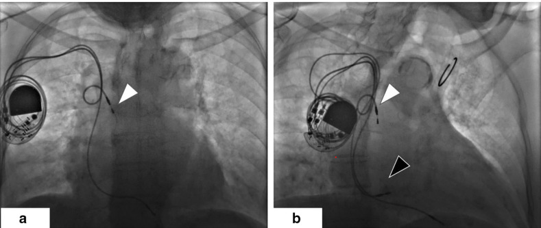 Navigating Complications in Cardiac Pacemakers: A Comprehensive Review ...