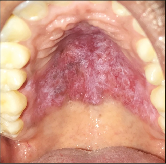 Bullous Lichen Planus: Case Report and Review - PMC