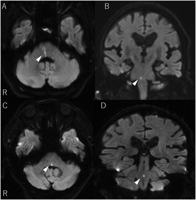 Conjugate eye deviation due to pontine infarction: Report of 2 cases - PMC