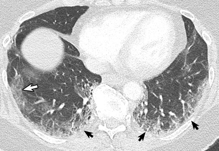 Peripheral ground-glass opacity (GGO) manifesting in a patient 5 days after symptoms of dyspnea, nausea, and body aches. Axial CT image shows faint rounded GGO (white arrow) in the right lower lobe laterally, with mild peripheral GGO in both lower lobes (black arrows).