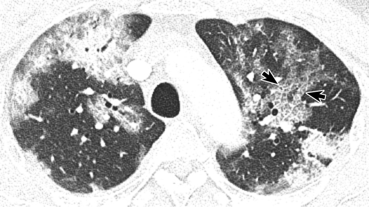 Crazy-paving pattern in the left upper lobe in a man with COVID-19. Axial CT image obtained 11 days after symptom onset shows intralobular lines within GGOs (arrows), which in combination with interlobular septal thickening create a cobblestone pattern characteristic of crazy paving.