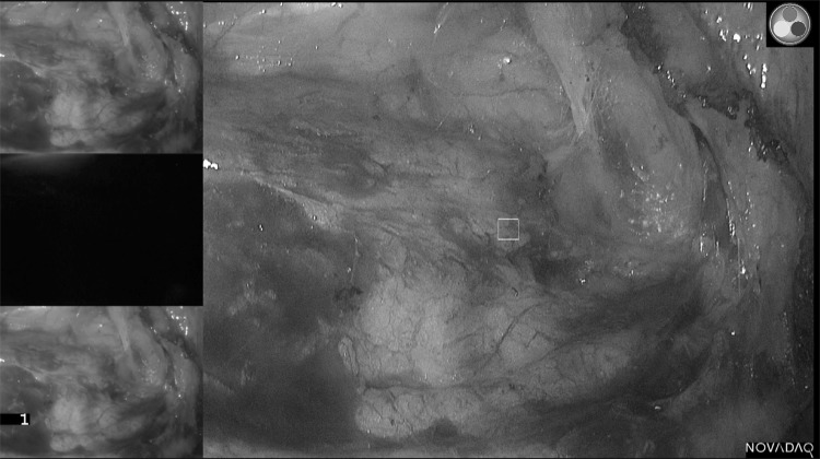 Methylene blue fluorescence of the ureter during colorectal surgery - PMC