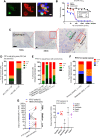 Figure 1. PTK7 expression profile by a novel PTK7-targeting antibody. A, mAb13 binding specificity. The specificity of an anti-PTK7 antibody mAb13 is shown as immunofluorescence colocalization of red mAb staining and green GFP-tagged target in 293T of overexpressed PTK7 in 293T cells. Representative negative staining on the un-transfected cells (blue only) is indicated by a red arrow. Scale bars, 20 μm. B, Cell binding affinity of humanized Ab13. Ab13 binds to PTK7-positive cell line OVCAR-3 at an affinity (EC50) of about 21 pmol/L measured by follow cytometry, comparing to EC50 of 60 pmol/L of the benchmark antibody h6M24. Data from 3 individual measurements. C, Representative images of IHC staining of mouse Ab13 (mAb13) on normal human tissue. PTK7 was expressed in the esophagus at basal keratinocytes but was negative in parabasal epithelium cells. Scale bar, 50 μm. D, PTK7 expression in SCLC and liver cancer. The positive rate (%) and the number (n) of SCLC and liver cancer patient samples surveyed were indicated. Scale bar, 20 μm. E, PTK7 expression in squamous cell carcinomas. The positive rate (%) and the number (n) of patient samples surveyed were indicated for each squamous cell cancer type. IHC assays were done using mAb13 on archived individual patient tissue samples. F, PTK7 expression increased in rectal cancer with metastasis. Tabulation of PTK7 expression in primary or metastatic rectal cancer. G, PTK7 expression level defined by the number of PTK7 molecules per cancer cell measured by flow cytometry (QIFIKIT using mAb13). Left, HER2 expression on the same cell line was shown for comparison (connected by dotted lines). Expression level was classified as low, medium, and high by the number of target molecules per cell: 0–10,000 as low, 10,000–100,000 as medium, and 100,000–1 million as high. The average copy number/cell of PTK7 was 35,000 versus 120,000 for HER2. Right, PTK7 copy number on cell lines classified by tumor type.
